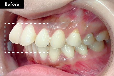 出っ歯治療前 - Oh my teeth マウスピース矯正Basicプラン症例 Case 04