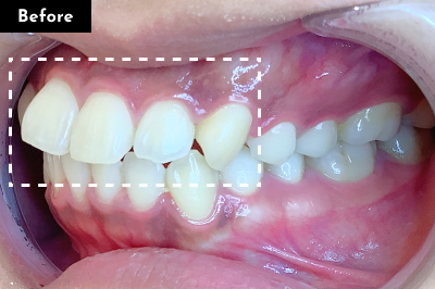 出っ歯治療前 - Oh my teeth マウスピース矯正Proプラン症例 Case 06