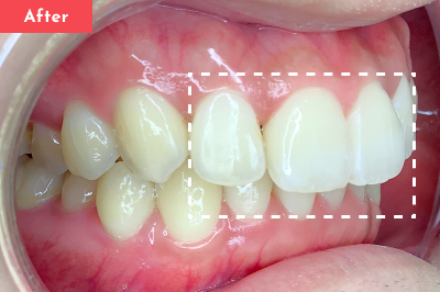 出っ歯治療後 - Oh my teeth マウスピース矯正Basicプラン8ヶ月の症例 Case 09