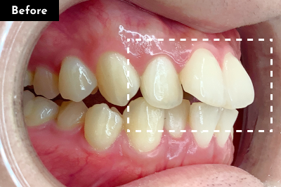 出っ歯治療前 - Oh my teeth マウスピース矯正Basicプラン症例 Case 09