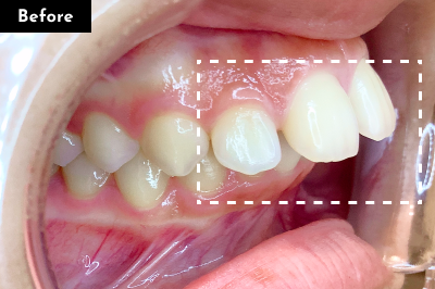 出っ歯治療前 - Oh my teeth マウスピース矯正Basicプラン症例 Case 11