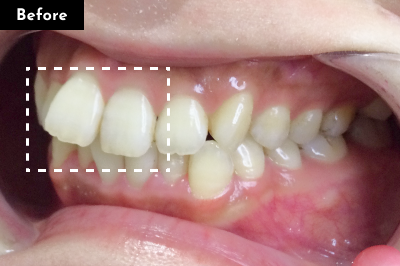 出っ歯治療前 - Oh my teeth マウスピース矯正Proプラン症例 Case 12
