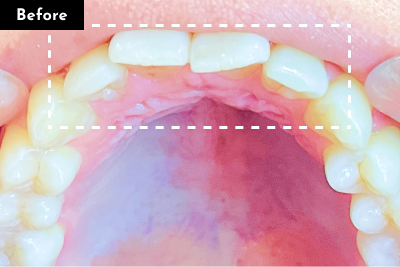 叢生治療前 - Oh my teeth マウスピース矯正Liteプラン症例 Case 14