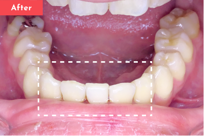 叢生治療後 - Oh my teeth マウスピース矯正Basicプラン4ヶ月の症例 Case 15