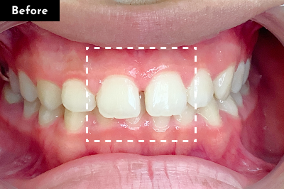 すきっ歯治療前 - Oh my teeth マウスピース矯正Basicプラン症例 Case 24
