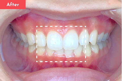 すきっ歯治療後 - Oh my teeth マウスピース矯正Basicプラン5ヶ月の症例 Case 25