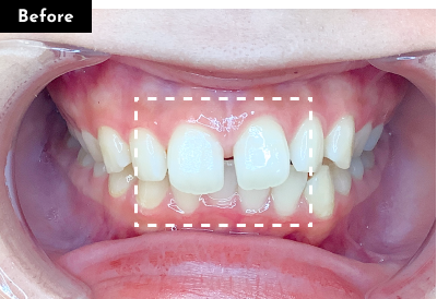 すきっ歯治療前 - Oh my teeth マウスピース矯正Basicプラン症例 Case 25