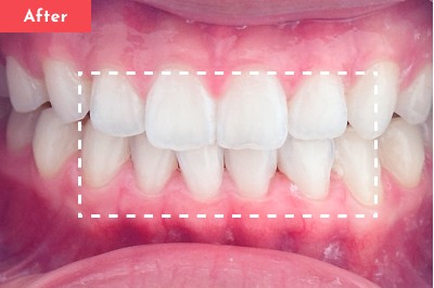 すきっ歯治療後 - Oh my teeth マウスピース矯正Basicプラン4ヶ月の症例 Case 26