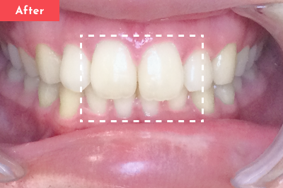 すきっ歯治療後 - Oh my teeth マウスピース矯正Basicプラン3ヶ月の症例 Case 30